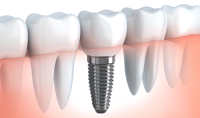 Implantes bucales