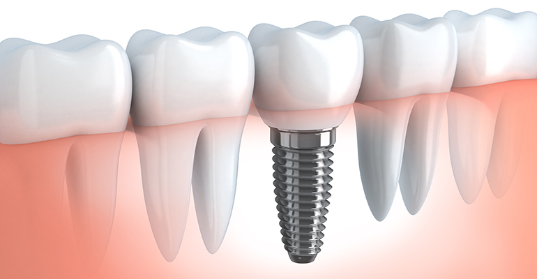 Implantes bucales