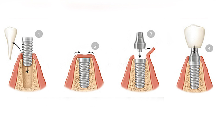 Implantes bucales, proceso.